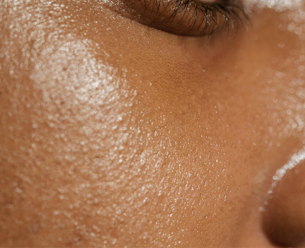 Close-up of facial skin for microneedling in Calgary mobile version